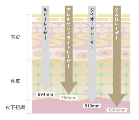 レーザー